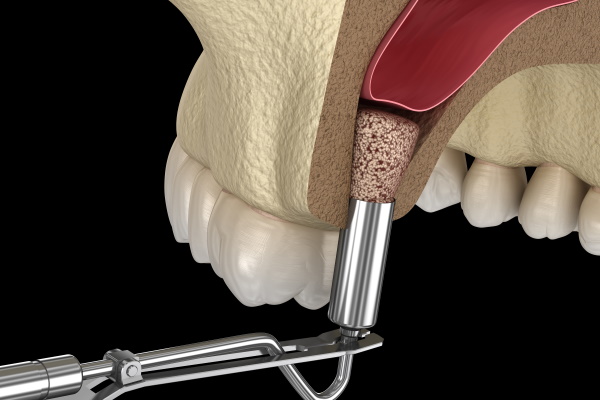 Sinus Lift Surgery - Adding new bone. 3D illustration